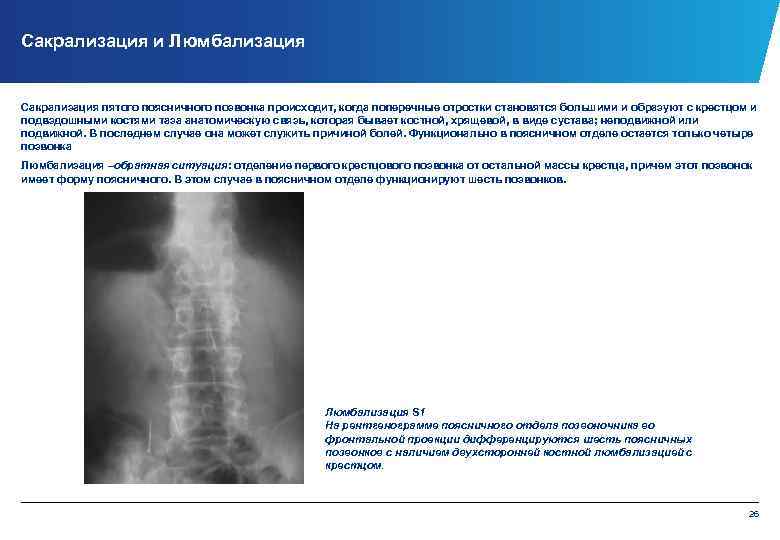 Сакрализация и Люмбализация Сакрализация пятого поясничного позвонка происходит, когда поперечные отростки становятся большими и