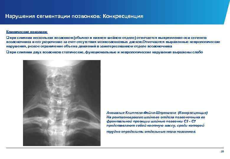 Нарушения сегментации позвонков: Конкресценция Клинические признаки: qпри слиянии нескольких позвонков (обычно в нижнем шейном