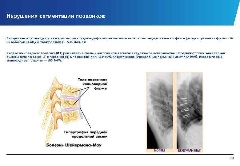 Нарушения сегментации позвонков Вследствие остеохондропатии наступает клиновидная деформация тел позвонков за счет недоразвития апофизов