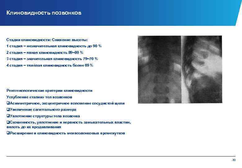 Клиновидность позвонков Стадии клиновидности: Снижение высоты: 1 стадия − незначительная клиновидность до 90 %