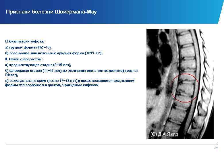 Признаки болезни Шойермана Мау I. Локализация кифоза: а) грудная форма (Th 5− 10), б)