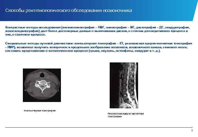 Способы рентгенологического обследования позвоночника Контрастные методы исследования (пневмомиелография – ПМГ, миелография – МГ, дискография