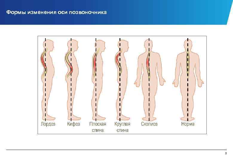 Формы изменения оси позвоночника © 2013 ЗАО «КПМГ» , компания, зарегистрированная в соответствии с