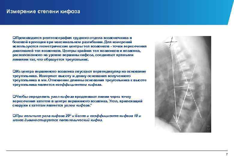 Измерение степени кифоза q. Производится рентгенография грудного отдела позвоночника в боковой проекции при максимальном