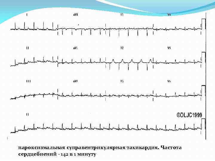 Пароксизма тахиаритмии. Суправентрикулярная пароксизмальная тахикардия. Пароксизмальная тахиаритмия. Пароксизмальная желудочковая тахикардия классификация. Синусовая тахиаритмия.