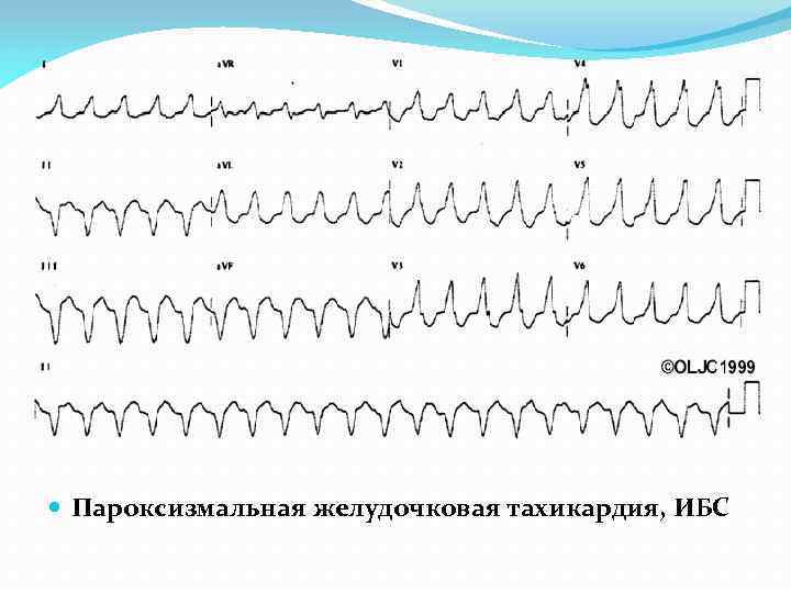  Пароксизмальная желудочковая тахикардия, ИБС 