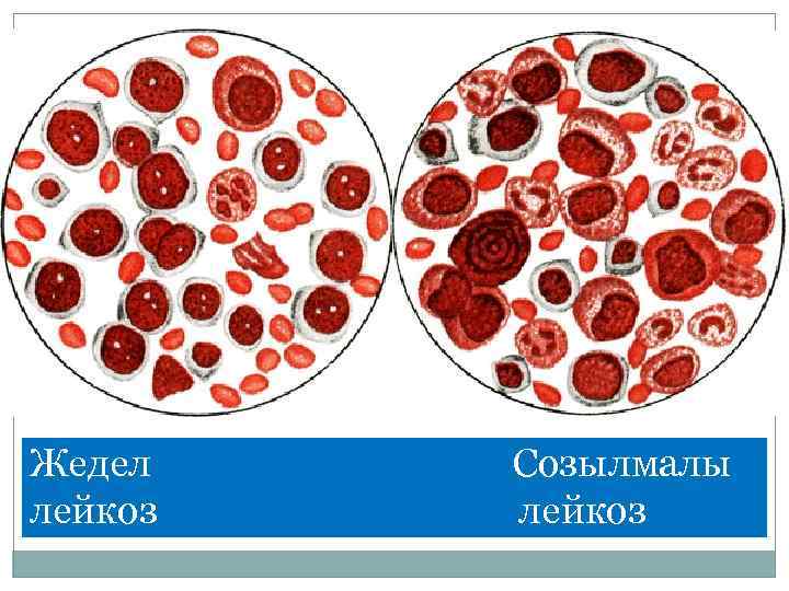 Жедел лейкоз Созылмалы лейкоз 