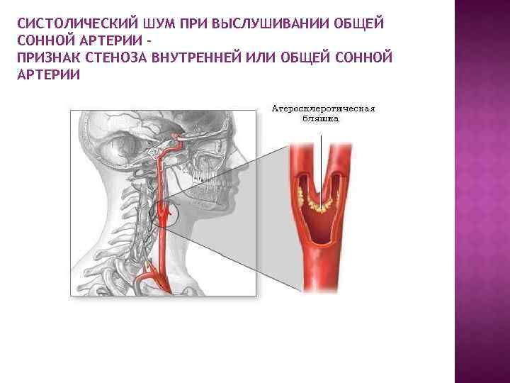 Сонная артерия симптомы