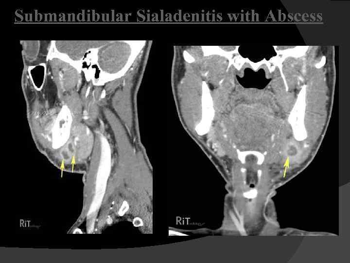 Submandibular Sialadenitis with Abscess 