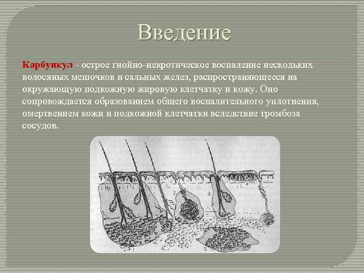 Введение Карбункул - острое гнойно-некротическое воспаление нескольких волосяных мешочков и сальных желез, распространяющееся на