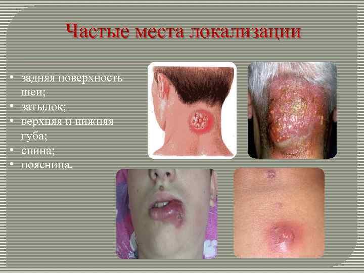 Частые места локализации • задняя поверхность шеи; • затылок; • верхняя и нижняя губа;