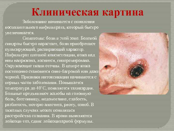 Клиническая картина Заболевание начинается с появления воспалительного инфильтрата, который быстро увеличивается. Симптомы: боли в