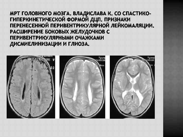 МРТ ГОЛОВНОГО МОЗГА. ВЛАДИСЛАВА К. СО СПАСТИКОГИПЕРКИНЕТИЧЕСКОЙ ФОРМОЙ ДЦП. ПРИЗНАКИ ПЕРЕНЕСЕННОЙ ПЕРИВЕНТРИКУЛЯРНОЙ ЛЕЙКОМАЛЯЦИИ. РАСШИРЕНИЕ