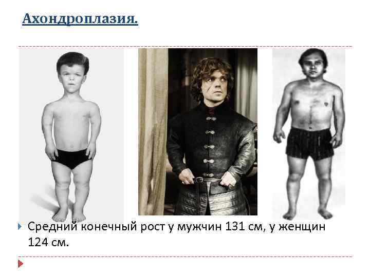 Ахондроплазия. Средний конечный рост у мужчин 131 см, у женщин 124 см. 