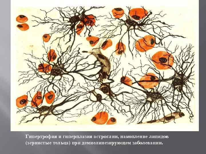 Гипертрофия и гиперплазия астроглии, накопление липидов (зернистые тельца) при демиелинезирующем заболевании. 