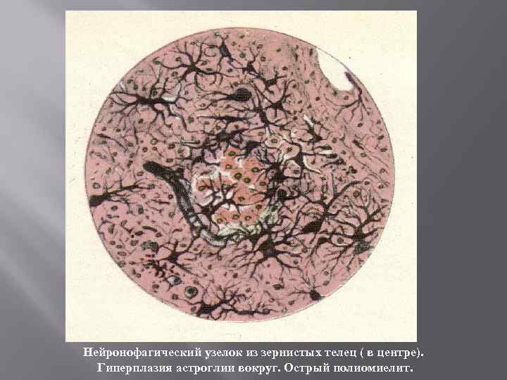 Нейронофагический узелок из зернистых телец ( в центре). Гиперплазия астроглии вокруг. Острый полиомиелит. 