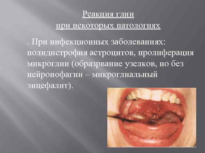 Реакция глии при некоторых патологиях. При инфекционных заболеваниях: полидистрофия астроцитов, пролиферация микроглии (образрвание узелков,