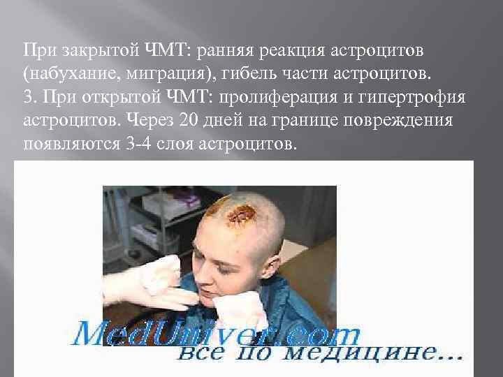 При закрытой ЧМТ: ранняя реакция астроцитов (набухание, миграция), гибель части астроцитов. 3. При открытой