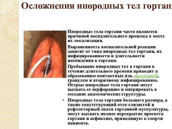 Осложнения инородных тел гортани Инородные тела гортани часто являются причиной воспалительного процесса в месте