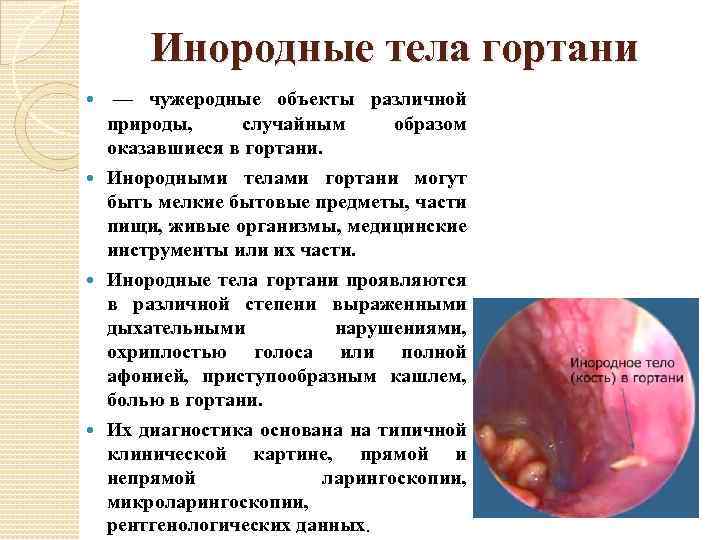 Инородные тела гортани — чужеродные объекты различной природы, случайным образом оказавшиеся в гортани. Инородными