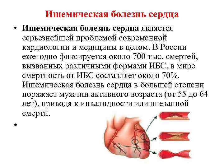 Ишемическая болезнь сердца • Ишемическая болезнь сердца является серьезнейшей проблемой современной кардиологии и медицины