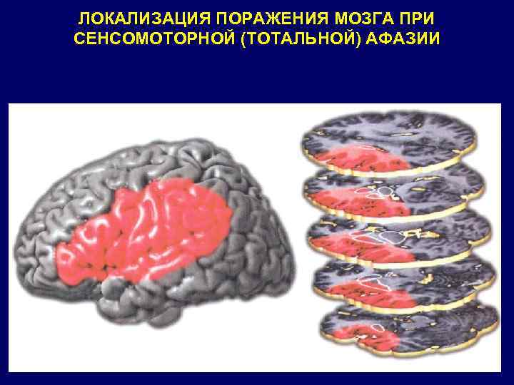 ЛОКАЛИЗАЦИЯ ПОРАЖЕНИЯ МОЗГА ПРИ СЕНСОМОТОРНОЙ (ТОТАЛЬНОЙ) АФАЗИИ 