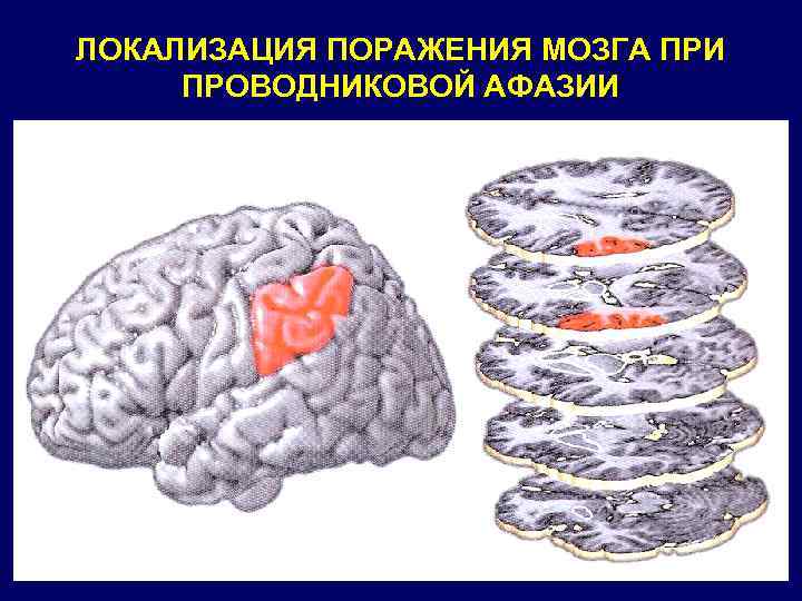 ЛОКАЛИЗАЦИЯ ПОРАЖЕНИЯ МОЗГА ПРИ ПРОВОДНИКОВОЙ АФАЗИИ 