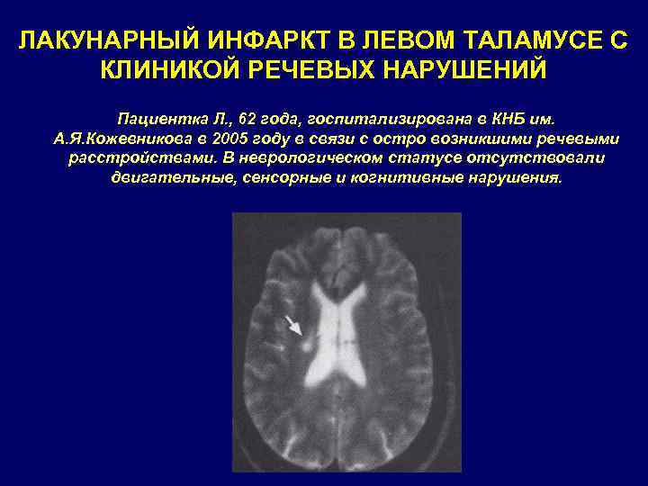 ЛАКУНАРНЫЙ ИНФАРКТ В ЛЕВОМ ТАЛАМУСЕ С КЛИНИКОЙ РЕЧЕВЫХ НАРУШЕНИЙ Пациентка Л. , 62 года,