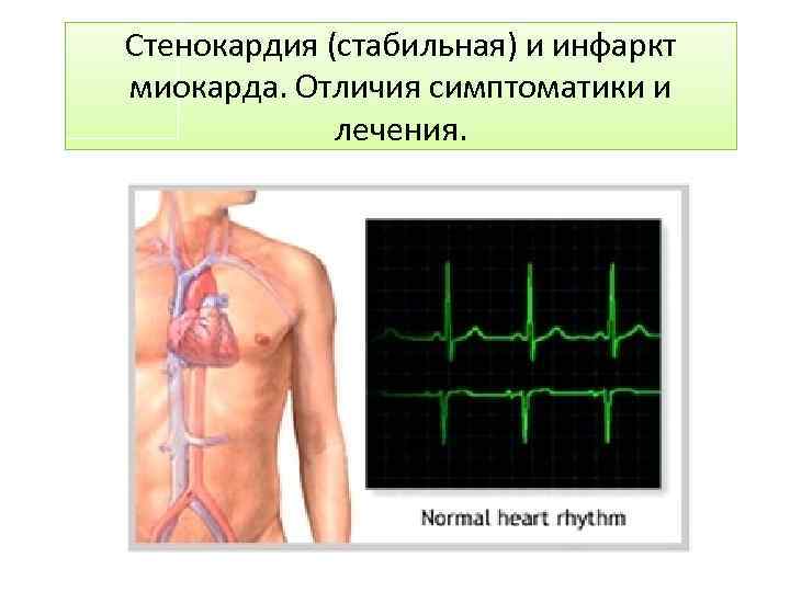 Атеросклероз и инфаркт миокарда различия. Отличие между инфаркт миокарда и стенокардии. Стабильная стенокардия и инфаркт миокарда. Различие инфаркта миокарда. Стенокардия и инфаркт миокарда отличия таблица.