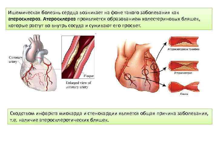 Презентация ишемия сердца