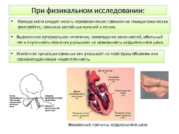 Сатурация при инфаркте