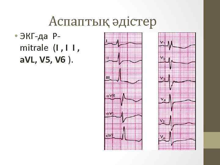 Аспаптық әдістер • ЭКГ-да Pmitrale (I , I I , a. VL, V 5,