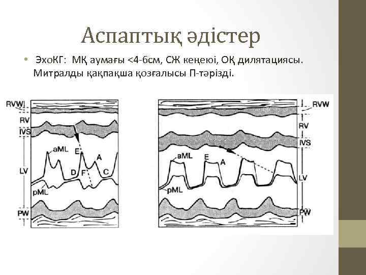 Аспаптық әдістер • Эхо. КГ: МҚ аумағы <4 -6 см, СЖ кеңеюі, ОҚ дилятациясы.