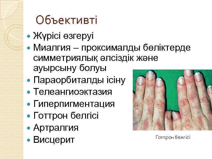 Объективті Жүрісі өзгеруі Миалгия – проксималды бөліктерде симметриялық әлсіздік және ауырсыну болуы Параорбиталды ісіну