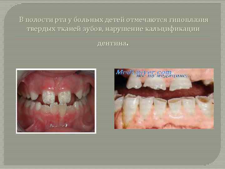  В полости рта у больных детей отмечаются гипоплазия твердых тканей зубов, нарушение кальцификации