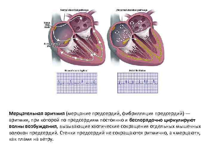Мерцательная аритмия (мерцание предсердий, фибрилляция предсердий) — аритмия, при которой по предсердиям постоянно и