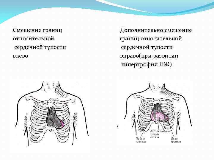 Смещение границ Дополнительно смещение относительной границ относительной сердечной тупости сердечной тупости влево вправо(при развитии