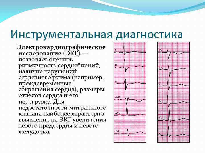 Инструментальная диагностика Электрокардиографическое исследование (ЭКГ) — позволяет оценить ритмичность сердцебиений, наличие нарушений сердечного ритма