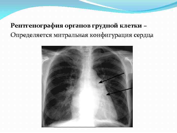 Рентгенография органов грудной клетки – Определяется митральная конфигурация сердца 