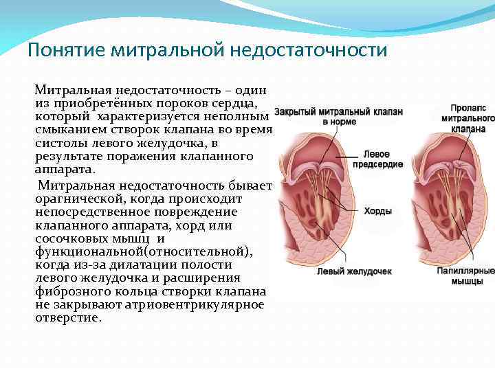 Понятие митральной недостаточности Митральная недостаточность – один из приобретённых пороков сердца, который характеризуется неполным