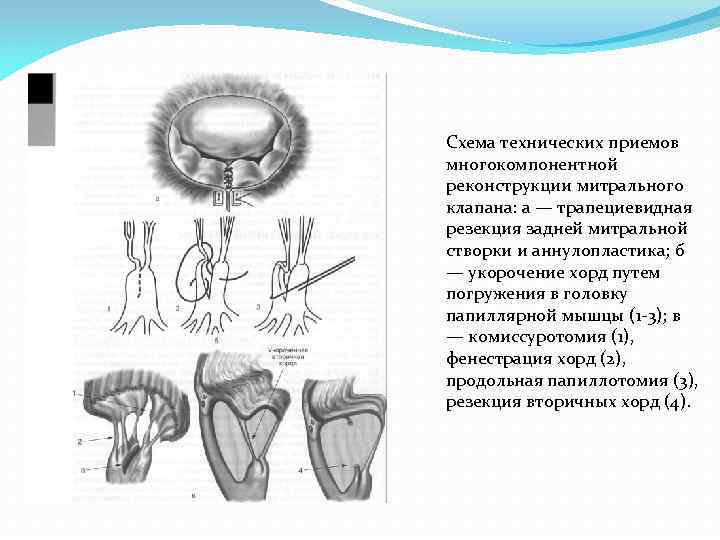 Схема технических приемов многокомпонентной реконструкции митрального клапана: а — трапециевидная резекция задней митральной створки