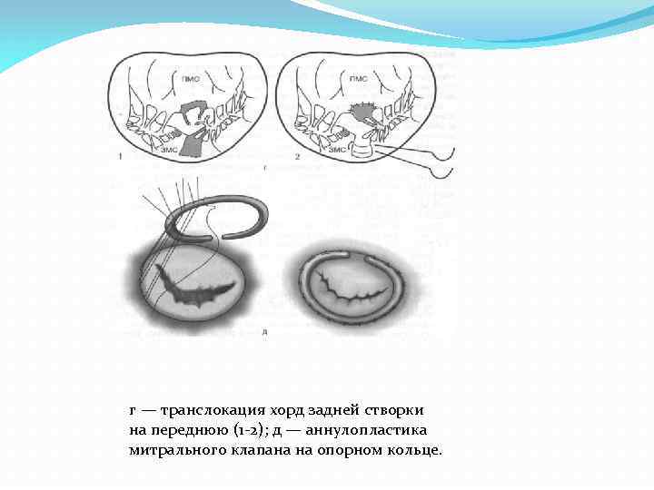 г — транслокация хорд задней створки на переднюю (1 -2); д — аннулопластика митрального