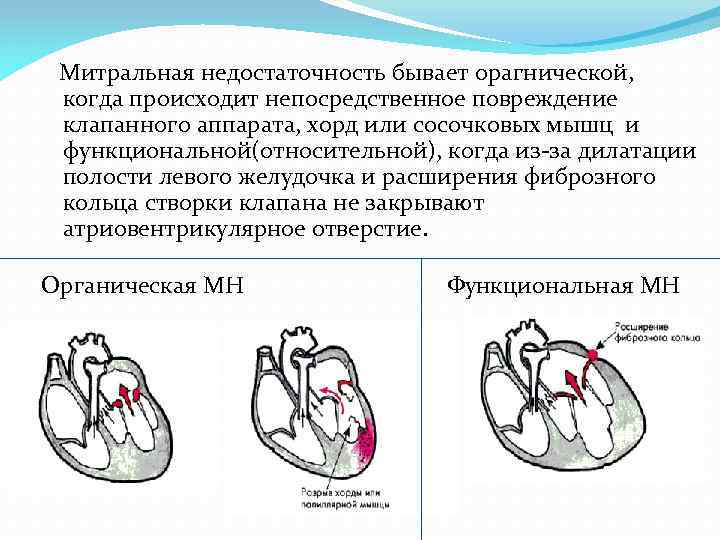 Недостаточность клапанов бпв справа