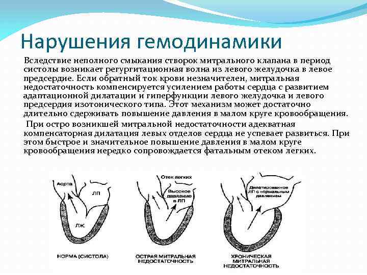 Нарушения гемодинамики Вследствие неполного смыкания створок митрального клапана в период систолы возникает регургитационная волна