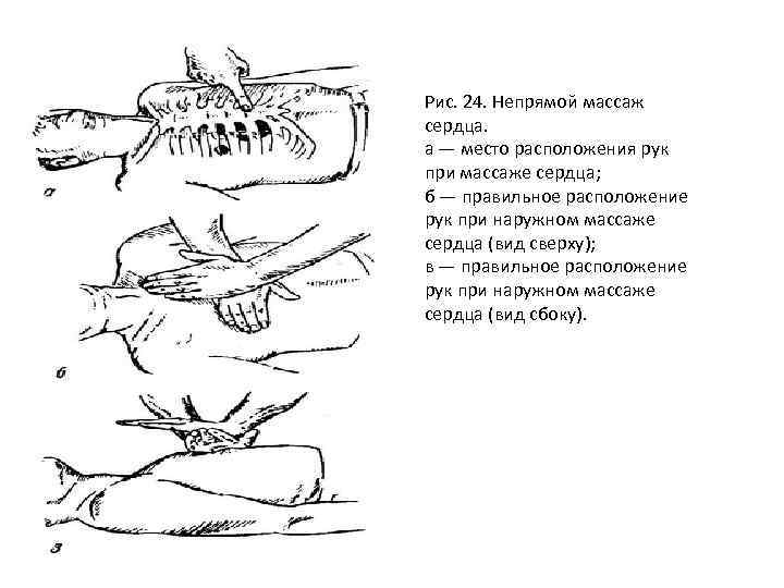 Руки при непрямом массаже сердца. Непрямой массаж сердца расположение ладоней. Положение ладоней при непрямом массаже сердца. Непрямой массаж сердца положение рук. Непрямой массаж сердца ладони располагаются.