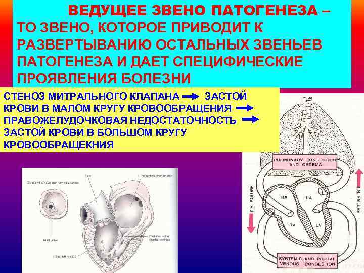 ВЕДУЩЕЕ ЗВЕНО ПАТОГЕНЕЗА – ТО ЗВЕНО, КОТОРОЕ ПРИВОДИТ К РАЗВЕРТЫВАНИЮ ОСТАЛЬНЫХ ЗВЕНЬЕВ ПАТОГЕНЕЗА И