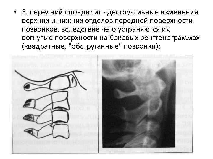  • 3. передний спондилит - деструктивные изменения верхних и нижних отделов передней поверхности