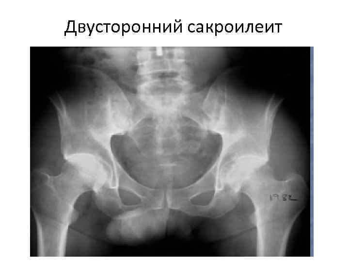Двусторонний сакроилеит 