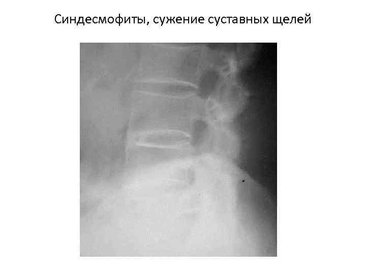 Синдесмофиты, сужение суставных щелей 