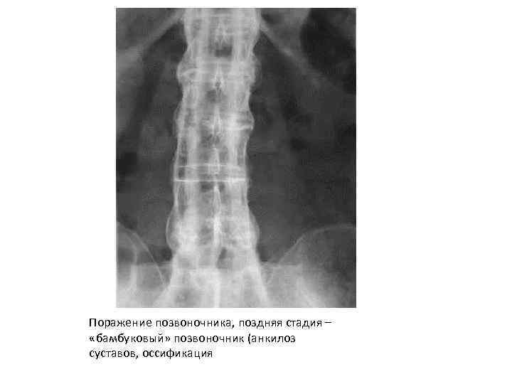 Поражение позвоночника, поздняя стадия – «бамбуковый» позвоночник (анкилоз суставов, оссификация 
